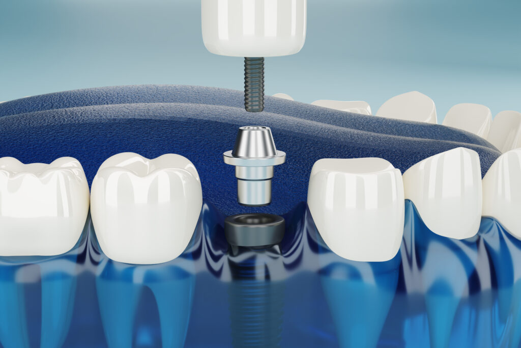 close up component of dental implants transparent. 3d rendering.