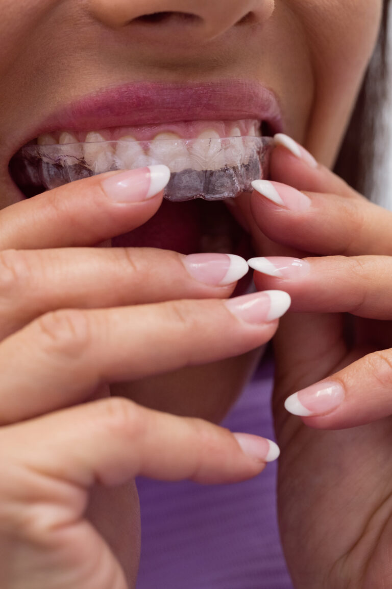 close up of female patient wearing braces in dental clinic